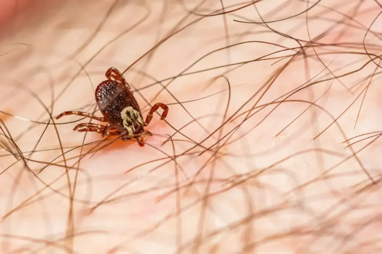 American dog tick crawling on human skin with visible legs and body markings.